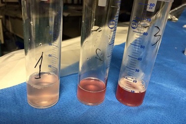 Hội chẩn nước ngoài chữa ca bệnh 9 năm ho ra máu