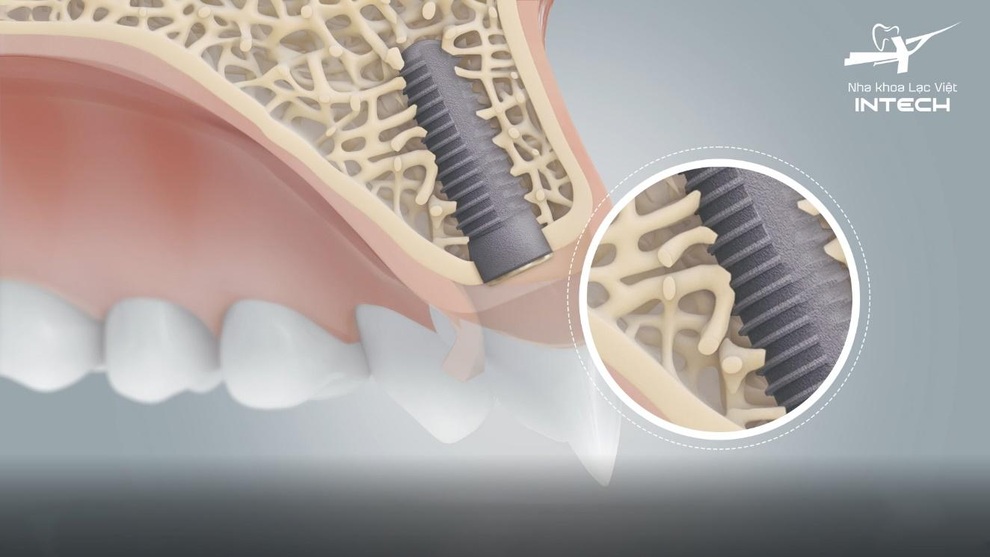 Trồng răng implant công nghệ Safe-tech - bước đột phá ngành nha khoa thế giới - 3 Trồng răng implant công nghệ Safe-tech - bước đột phá ngành nha khoa thế giới - 3