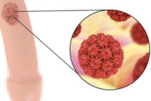 Người trẻ mắc ung thư vùng kín, vaccine có giúp điều trị bệnh?