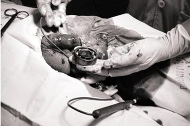 “Của quý” phù nề vì đeo vòng bi để… tăng kích cỡ