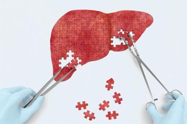 Gan nhiễm mỡ là gì và 3 biến chứng nguy hiểm thường gặp