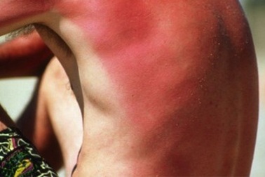 Nguy cơ ung thư da từ những kỳ nghỉ mát