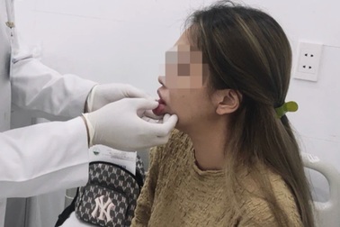 Tiêm filler môi có an toàn?