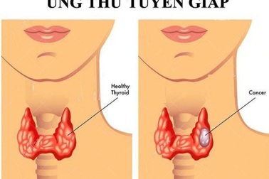 Điều trị Iod phóng xạ là gì?