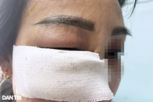 Đi tiêm tan filler ở thẩm mỹ viện: Cẩn thận "lành thành què"