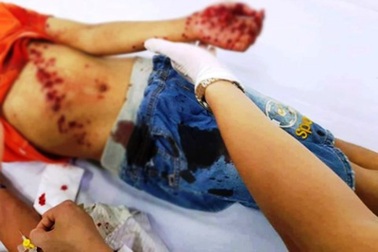 Bé 8 tuổi nguy kịch vì đồ chơi bất ngờ phát nổ