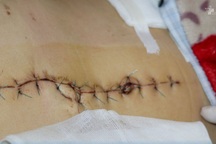 Nam công nhân bị đâm lộ hết ruột ra bên ngoài, thủng dạ dày, gan