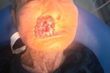 Từ nốt ruồi nhỏ trên mặt, sau 3 năm phát triển thành khối u, giòi làm tổ