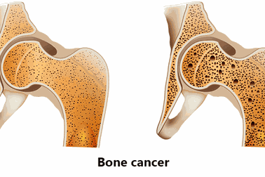 Các triệu chứng thường gặp của ung thư xương