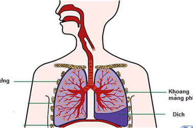 Chẩn đoán xác định ung thư phổi
