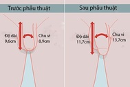 “Trình làng” kỹ thuật tăng kích thước “cậu nhỏ” đơn giản đến ngạc nhiên