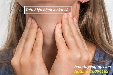 Dấu hiệu bệnh bướu cổ là gì? Cách điều trị ra sao?