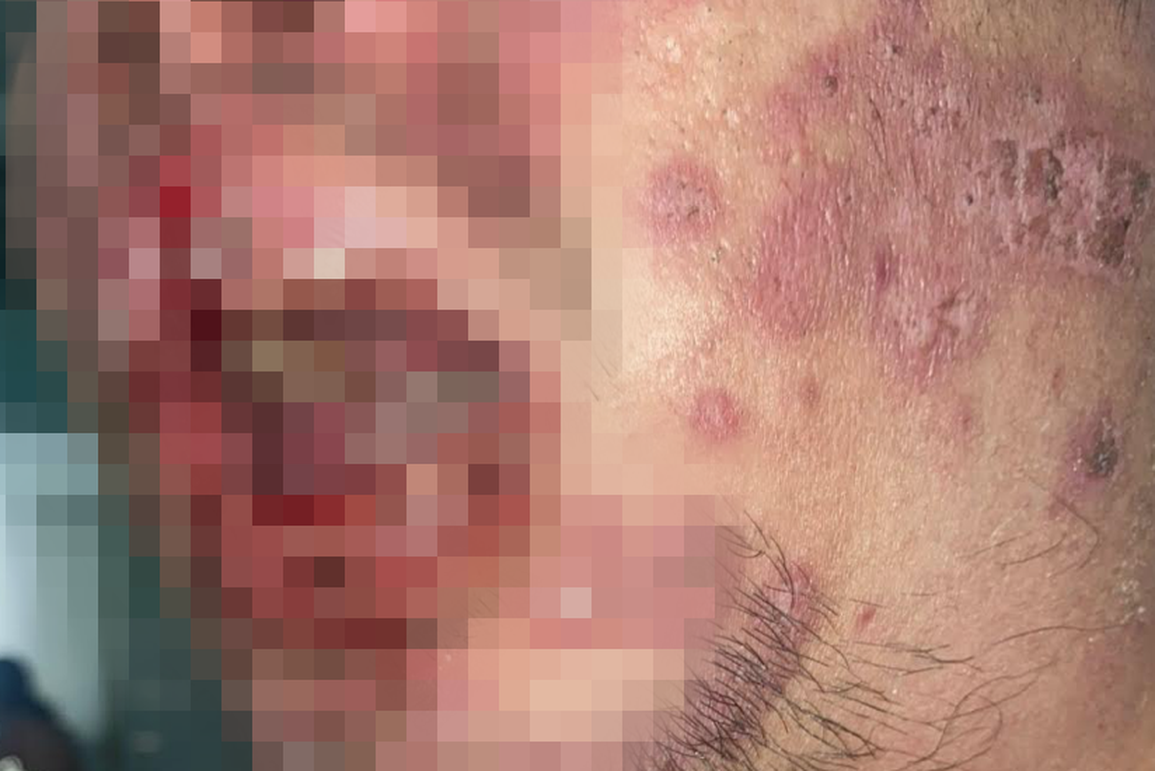 Người đàn ông lở loét cả người vì căn bệnh cả thế giới mới tìm ra 95 ca - 1 Người đàn ông lở loét cả người vì căn bệnh cả thế giới mới tìm ra 95 ca - 1