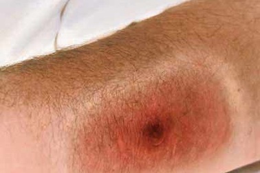 Điều trị bệnh than không khó!