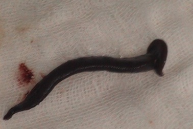 Gắp 1 con đỉa 15cm trong thanh quản một thanh niên