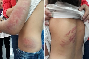 Bé gái lớp 4 bị bố đẻ đánh đập dã man