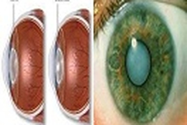 Suy giảm thị lực dẫn đến mù lòa: Nguyên nhân và giải pháp