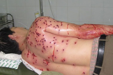 Quy định của pháp luật xử tội cố ý gây thương tích