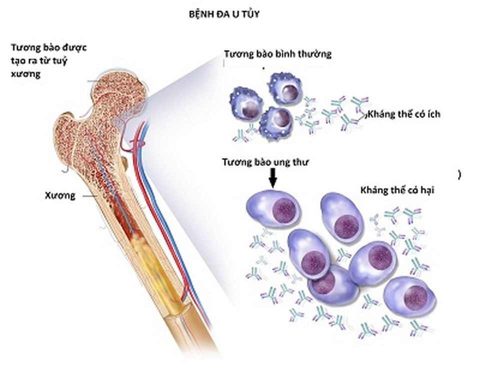 Liệu pháp gen dựa trên tế bào đầu tiên trị bệnh đa u tủy - 1 Liệu pháp gen dựa trên tế bào đầu tiên trị bệnh đa u tủy - 1