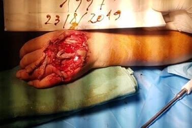 Thợ hồ bị máy trộn vữa cuốn dập nát bàn tay