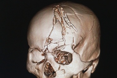 Xếp xương sọ vỡ nát, vá màng cứng cứu sống nam thanh niên