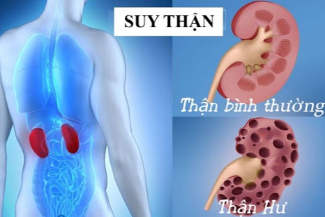 Thận suy yếu âm thầm, 7 việc cần làm ngay để bảo vệ - 1