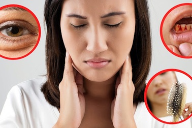 5 triệu chứng thiếu vitamin biểu hiện rõ trên khuôn mặt