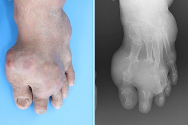 Bệnh gút: Chuyên gia chỉ rõ nguyên nhân gây tử vong, điều trị thất bại