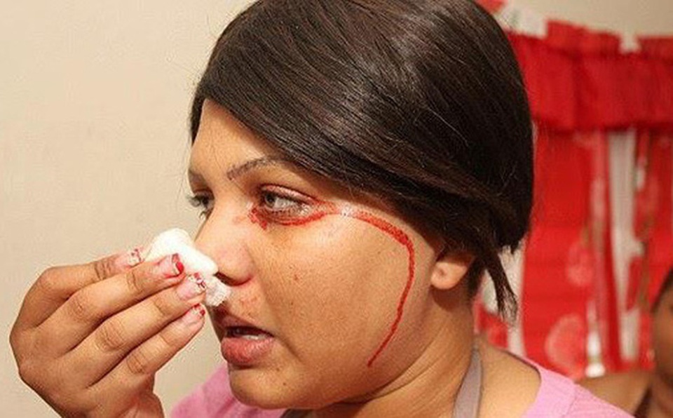 Người đàn ông đổ mồ hôi máu lần đầu tiên ghi nhận tại Việt Nam - 5 Người đàn ông đổ mồ hôi máu lần đầu tiên ghi nhận tại Việt Nam - 5