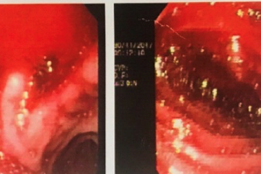 Tự điều trị sốt nhiều ngày, bệnh nhân ói ra máu