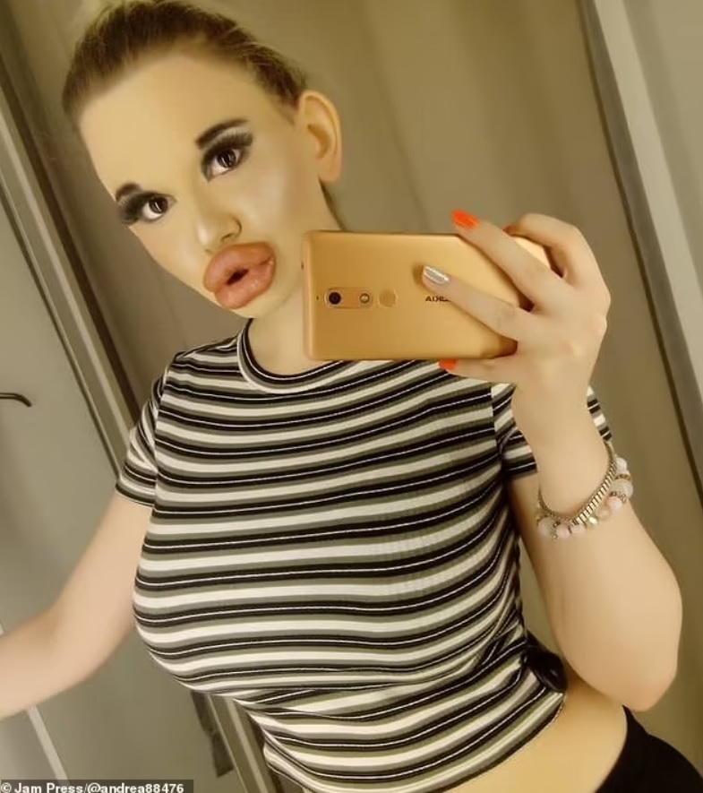 Cô gái bơm môi lần thứ 27 vì muốn trông giống... búp bê - 1