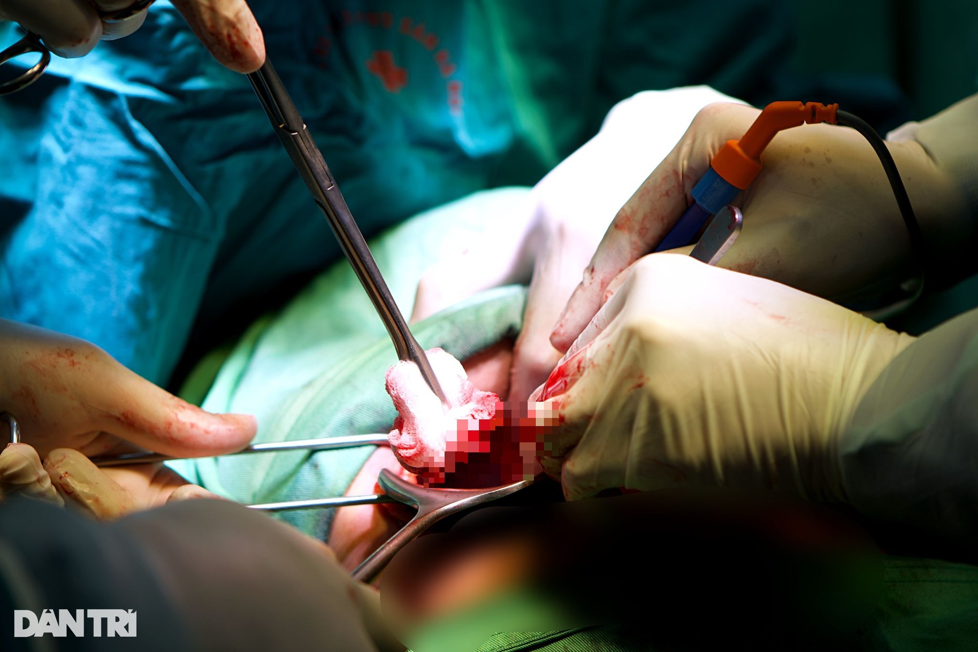Nghẹt thở cuộc đua máu trong phòng mổ cấp cứu sản khoa - 14 Nghẹt thở cuộc đua máu trong phòng mổ cấp cứu sản khoa - 14