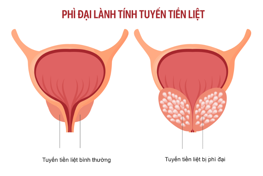 Thuyên tắc mạch điều trị u tiền liệt tuyến: Không cần phẫu thuật, hồi phục nhanh - 2