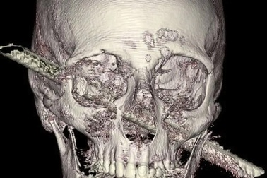 Thoát chết thần kỳ dù bị thanh sắt xuyên ngang mặt