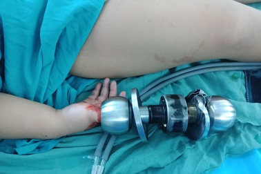 Bé trai 3 tuổi suýt mất ngón tay vì kẹt vào ổ khóa