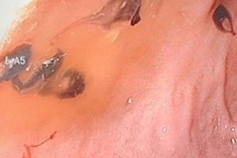 Gan lúc nhúc sán vì ăn quá nhiều gỏi hải sản tươi sống