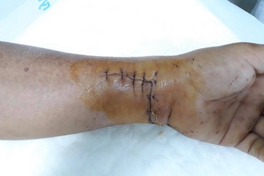 Cứu được bàn tay bệnh nhân bị mảnh kính cứa đứt mạch thần kinh