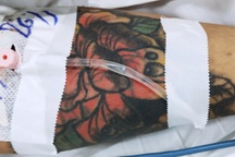 TPHCM: Thanh niên 20 tuổi lâm nguy sau khi đi xóa xăm tại cơ sở chui