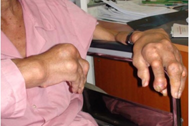 Lắng đọng tinh thể urat ở bệnh nhân gút