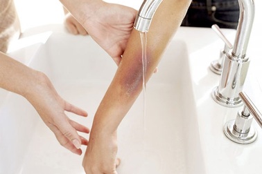 Nhầm vòi nước nóng, bé 2 tháng tuổi bỏng nặng