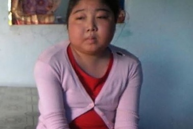 Bị xuất huyết giảm tiểu cầu miễn dịch, nữ sinh lớp 10 phù nề toàn thân vì không tiền chạy chữa