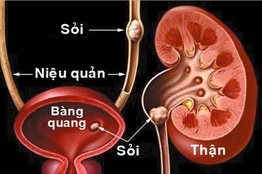 Bệnh sỏi thận: Chớ coi thường