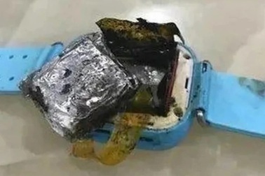 Bé gái 4 tuổi bị bỏng độ 3 vì smartwatch phát nổ trên tay