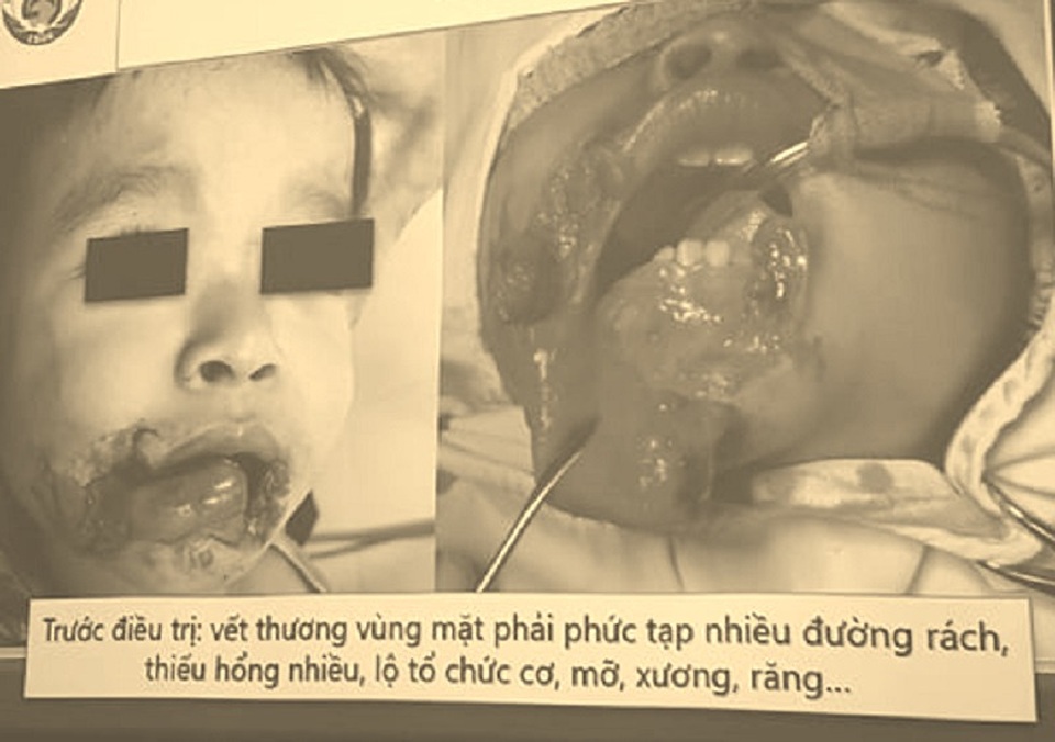 Đang ăn xúc xích, bé trai bị chó tấn công cướp đồ ăn, cắn vùng đầu mặt - 1 Đang ăn xúc xích, bé trai bị chó tấn công cướp đồ ăn, cắn vùng đầu mặt - 1