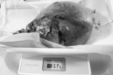 Phẫu thuật thành công cho bệnh nhân bị khối u xơ “khổng lồ”