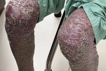 Hà Nội: Người đàn ông có "da rắn" vì căn bệnh thường gặp