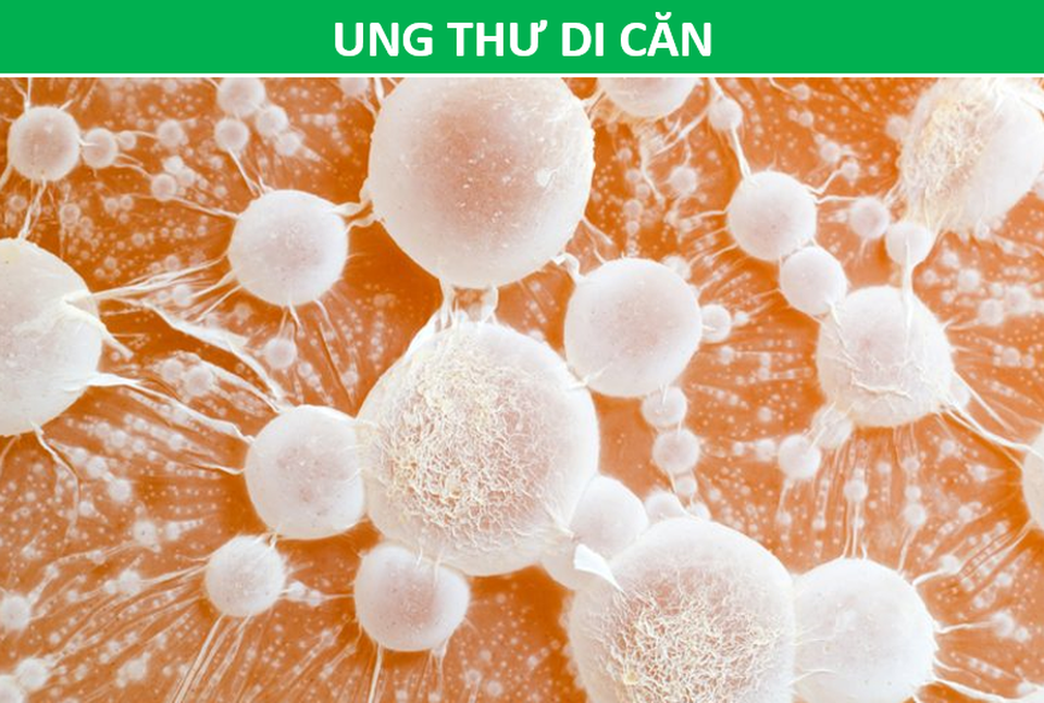 Đau vùng lưng dưới có thể là tín hiệu cảnh báo loại ung thư nào? - 5 Đau vùng lưng dưới có thể là tín hiệu cảnh báo loại ung thư nào? - 5