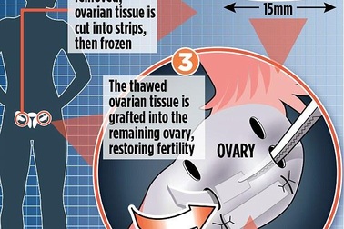 Phương pháp sinh con từ mô buồng trứng đông lạnh cho phụ nữ ung thư