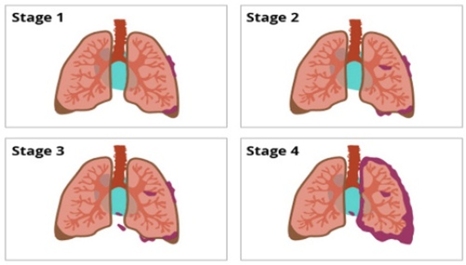 Các tác nhân gây ung thư phổi, căn bệnh “sát thủ” hàng đầu ở nam giới - 3 Các tác nhân gây ung thư phổi, căn bệnh “sát thủ” hàng đầu ở nam giới - 3