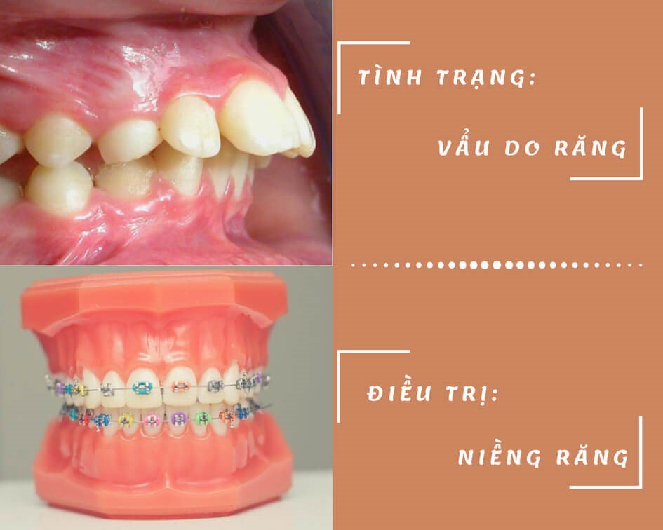 Răng bị vẩu